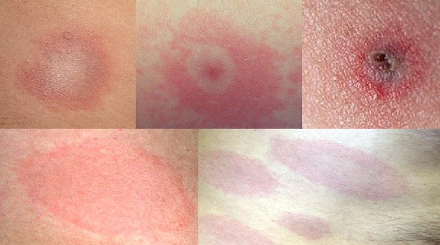 rumień wędrujący od kleszcza